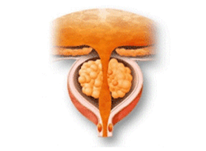 전립선비대증 사진3