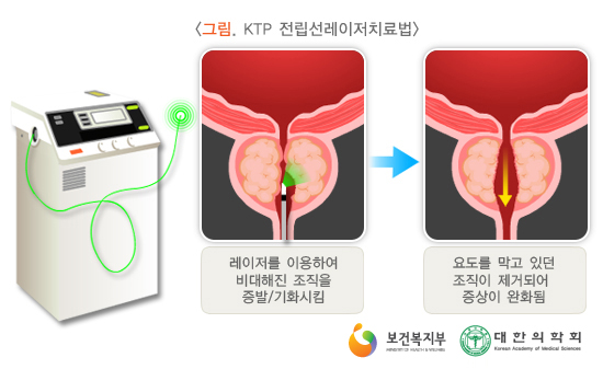 그림. KTP 전립선레이저치료법 - 1.레이저를 이용하여 비대해진 조직을 증발/기화시킴 2.요도를 막고 있던 조직이 제거되어 증상이 완화됨 보건복지부 대학의학회